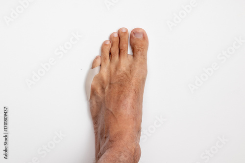 Silicone spacer, separator or protector for the condition tailor's bunion or bunionette. Male barefoot condition at the base of the little toes