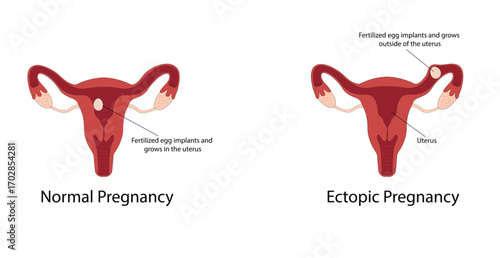 Ectopic pregnancy vector illustration