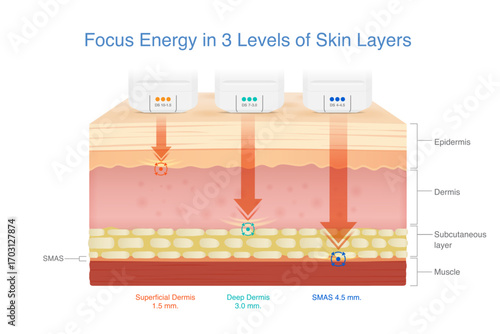 3 Medical devices shoot heat energy to the skin layer at three different depths to SMAS layer. Skin lifting with stimulating collagen and Elastin in skin with Ultherapy and Radio Frequency.