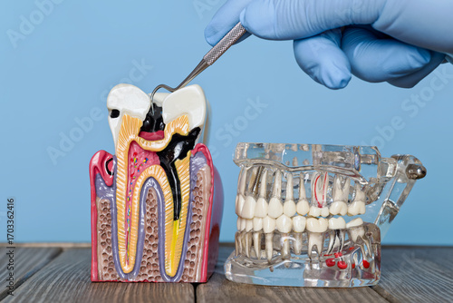 Dental decay model and full jaw model with explorer