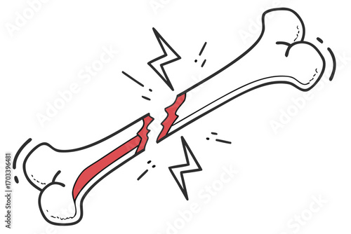 Broken Bone Illustration with Red Fracture.