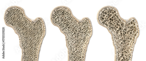 3D cross-section of human bone structure with varying density. Comparison of healthy bone, osteopenia, osteoporosis. Porous trabecular tissue anatomy, skeletal system, medical education, healthcare