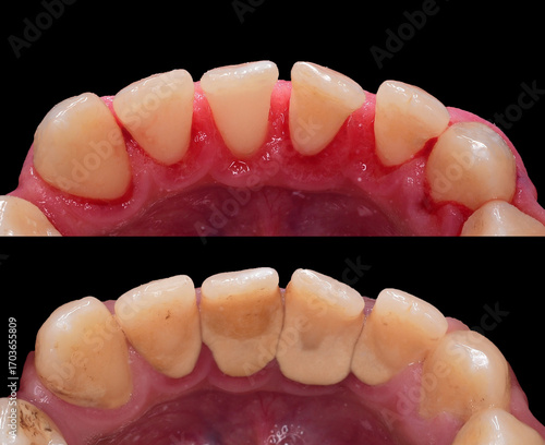 teeth tartar and calculus cleaning