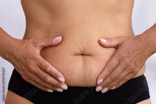 Fotografía Hands on belly with visible stretch marks