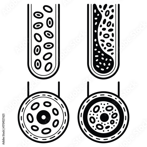 Minimalist black and white medical illustration of blood vessels and cross-sections showing normal and narrowed vessel with cells