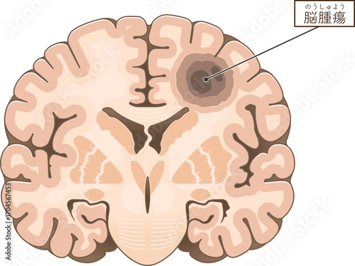 前頭断面_脳腫瘍のイラスト Brain tumor illustration