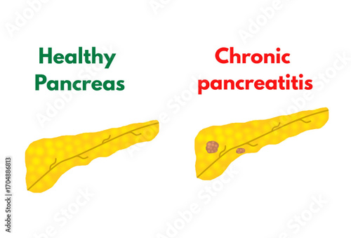 Healthy Pancreas versus chronic pancreatitiis pancreatic disease gastro problems useful for healthcare industries and related projects.eps