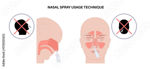 Proper nasal spray usage
