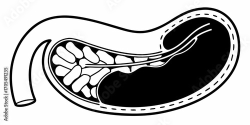 Illustration of a gallbladder with stones and ducts in black and white anatomical representation