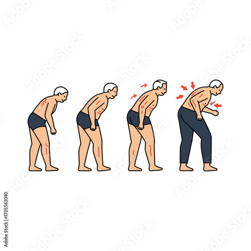 kyphosis progression stages illustrating spinal deformity postural change back pain and musculoskeletal disorders for medical education materials