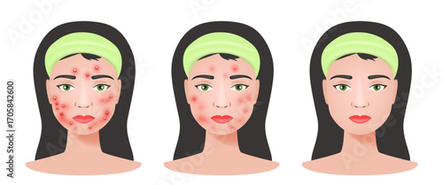 Acne skin and healthy skin. Girl with acne. Vector illustration