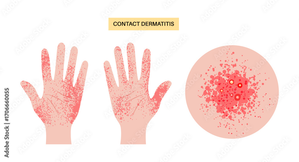 Obraz premium Contact dermatitis poster