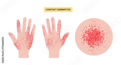 Contact dermatitis poster