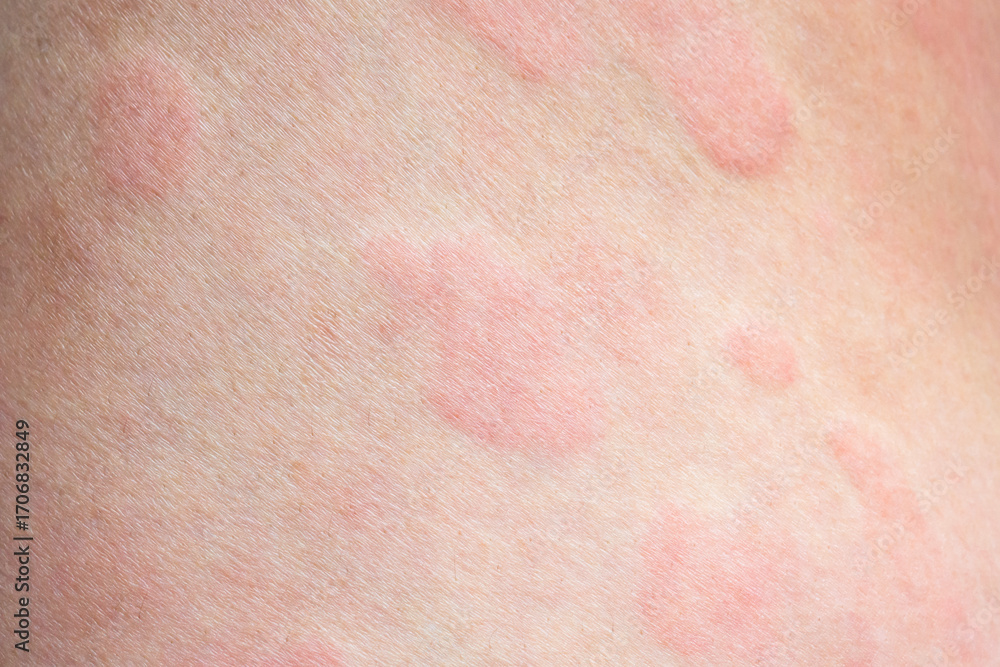 Fototapeta premium Skin allergy rash dermatitis texture close up background