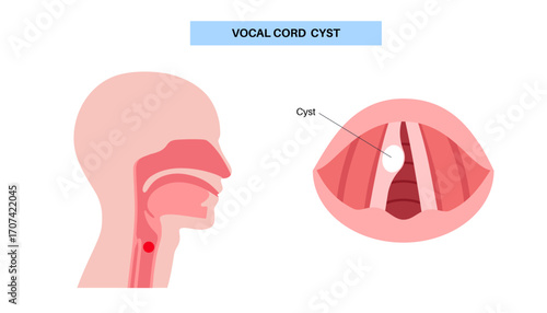Vocal cord cyst