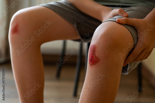 Broken bleeding knee - deep scratches on the skin with bruises. Child's leg injury close-up. The kid hurt his knee when he fell. Dried blood and scratched skin. Child injured his knee when he fell