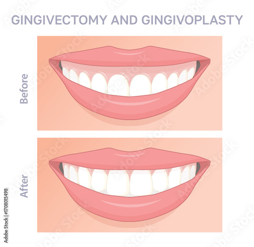 Before and after illustration of gingivectomy and gingivoplasty dental procedure, showing gum contouring and smile improvement.