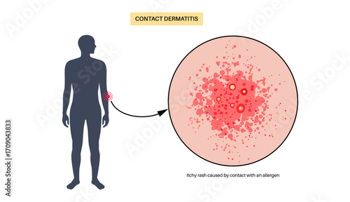 Contact dermatitis poster