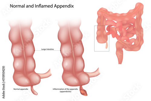 Normal and Inflamed Appendix Medical Illustration. The diagram compares a healthy appendix with one affected by appendicitis, highlighting the large intestine and the location of the appendix within t