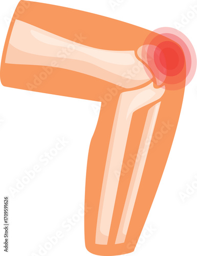 Medical illustration showing elbow bones and ligaments with red spot indicating painful area