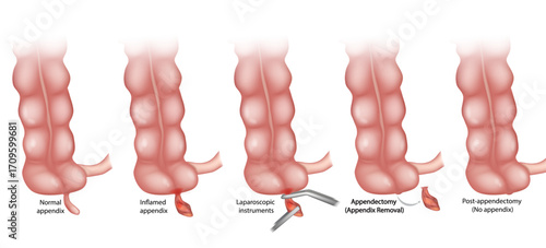 Educational medical illustration showing the stages of appendectomy, including a normal and inflamed appendix, laparoscopic instruments in use, surgical appendix removal, and post-appendectomy state.