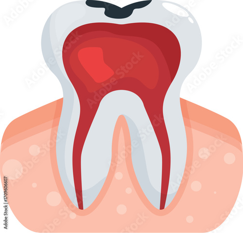 Diseased molar tooth with inflamed pulp requiring dental treatment