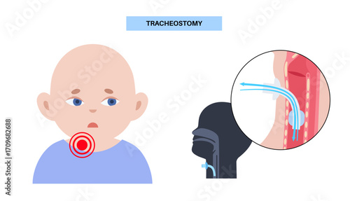 Tracheostomy medical poster