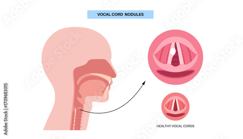 Vocal cord cyst