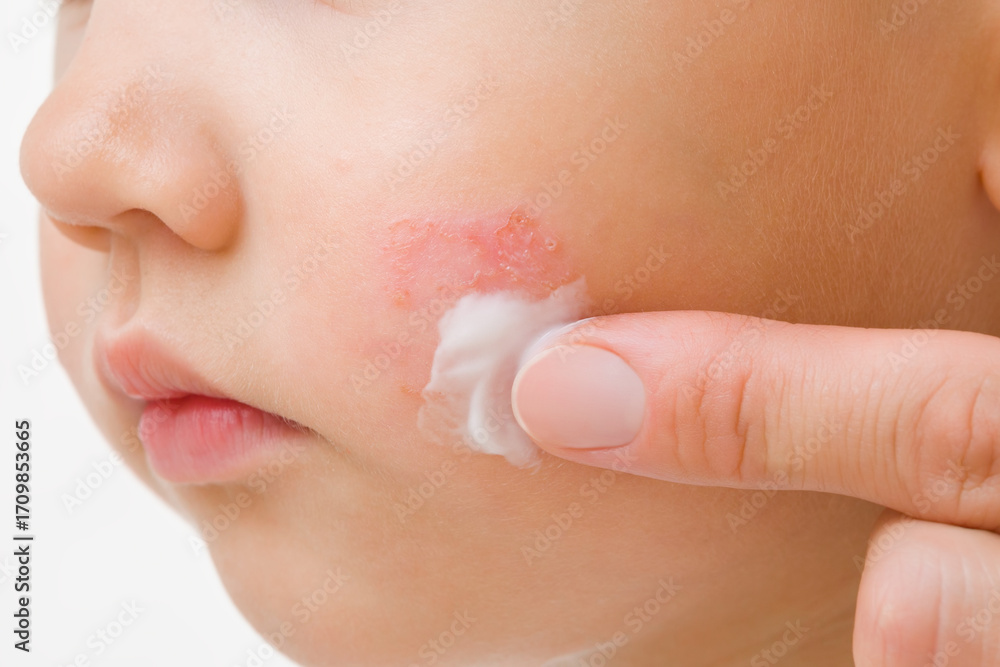 Naklejka premium Young adult mother finger applying white medical ointment on toddler boy cheek isolated on light gray background. Red rash on skin. Allergy from food. Care about baby body. Closeup. Front view.