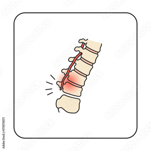 spinal disc herniation illustration showing nerve compression causing pain in the lower back perfect for health articles