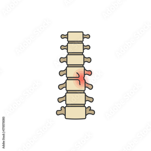 spinal disc herniation vertebral column inflammation and lower back pain concept illustration spinal health