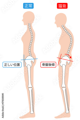 猫背と正常な姿勢の女性　背骨と骨盤
