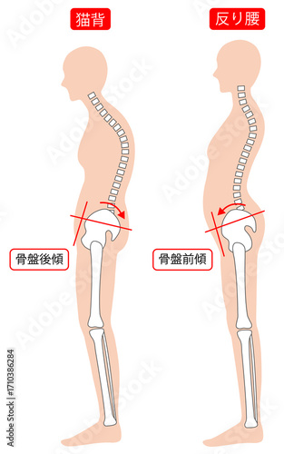 反り腰と猫背な姿勢の女性　背骨と骨盤