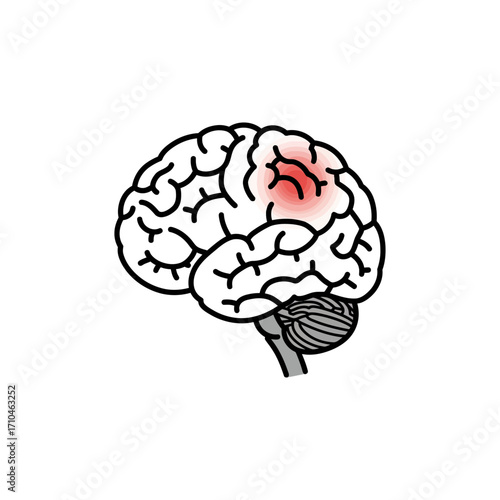 brain tumor illustration brain inflammation concept showing headache symptom and neurology disease problem risk for medical design