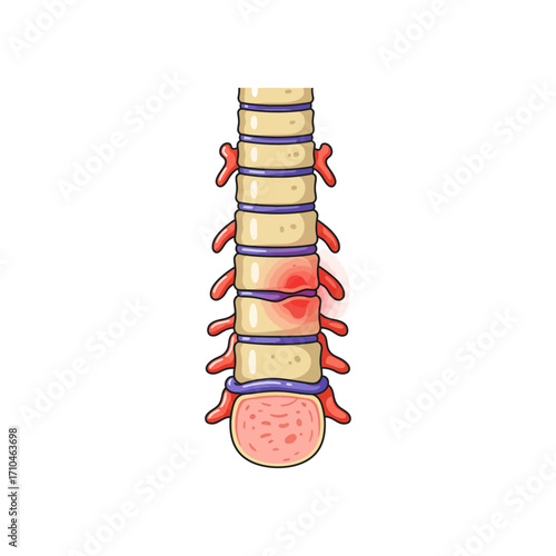 herniated disc illustration showing spinal cord injury and nerve damage with back pain issues spine problems