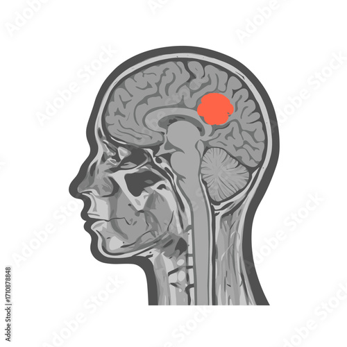 Brain tumor scan - vector medical illustration of a head profile with a highlighted red tumor in the cerebral cortex, demonstrating diagnosis with MRI or CT