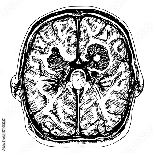 Vintage brain tumor scan illustration in detailed anatomical style  