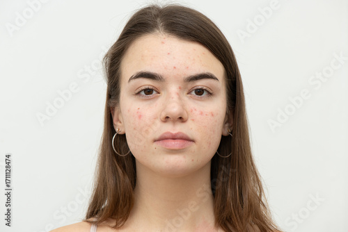 Portrait of young woman with acne on her face. Acne, skin care concept. Real photo.