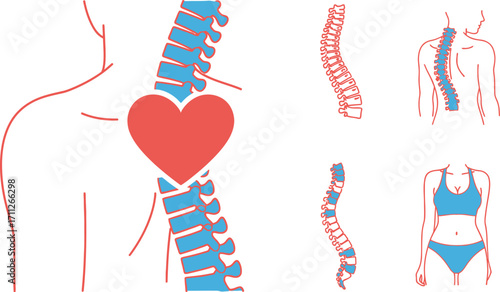 Illustration of scoliosis, a curvature of the spine