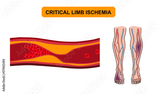 Critical limb ischemia, PAD. Ischemia in the legs and arms. Cholesterol, fat in human blood vessels. blockage in blood vessels. Vector illustration for medical poster, clinic or science study