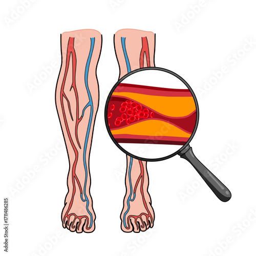 Peripheral artery disease. Ischemia in the legs and arms. Cholesterol, fat in human blood vessels. blockage in blood vessels. Vector illustration for medical poster, clinic or science study