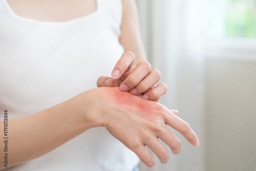 Obraz premium Dermatology asian young woman allergy, allergic reaction from atopic, insect bite, scratching itchy back of hand, red spot or rash of skin. Healthcare treatment of beauty. Isolated on white background