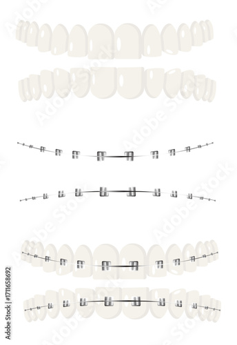 Dental Braces Orthodontic Set Isolated on White Background