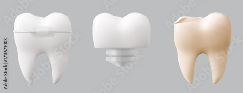 Realistic tooth collection with dental anatomy details - white molar with braces, crown implant on screw post, and yellow tooth. Medical dentistry illustrations for healthcare education design.