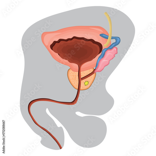 Diagram of prostate cancer illustration. Vector illustration