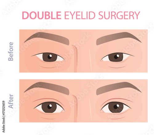 Vector medical illustration showing before and after results of double eyelid surgery (blepharoplasty).