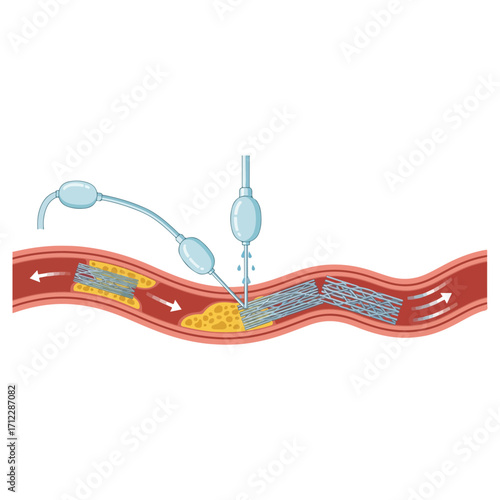 Medical procedure of angioplasty to open blocked artery.