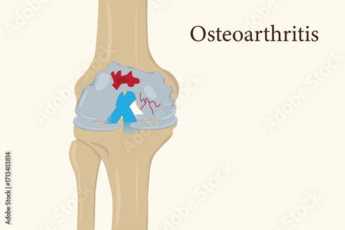 Medical illustration of osteoarthritis showing knee joint damage and cartilage degeneration. eps 10