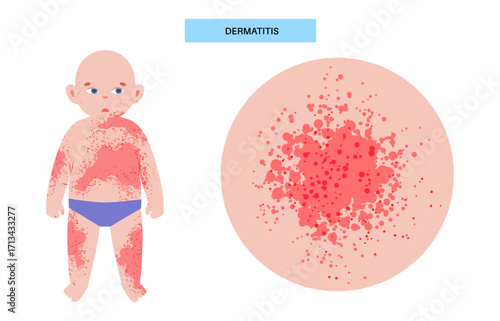 Dermatitis medical poster