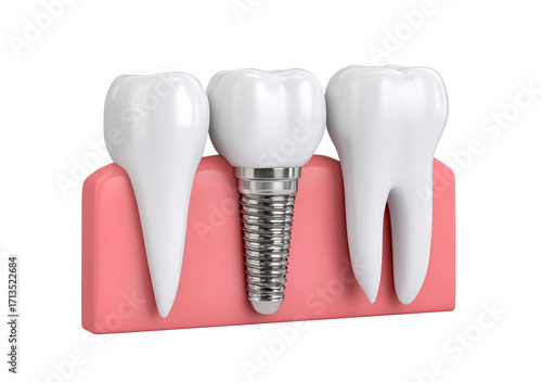 Dental implant model with healthy teeth and gums illustrated on transparent background, PNG